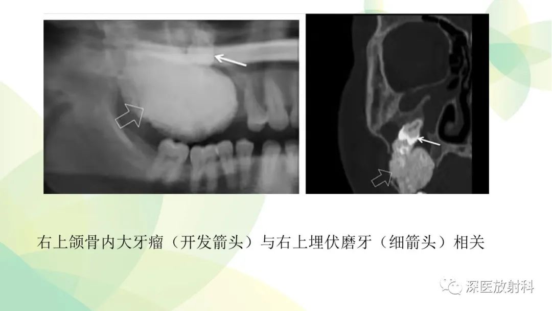 影像PPT - 【PPT】颌骨病变的影像表现-38