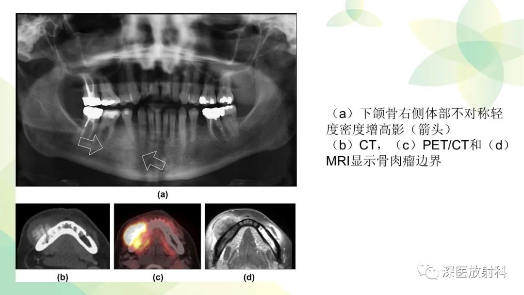 影像PPT - 【PPT】颌骨病变的影像表现-46