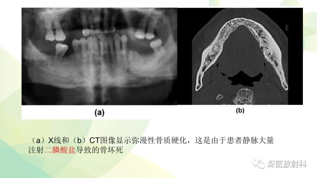 影像PPT - 【PPT】颌骨病变的影像表现-49