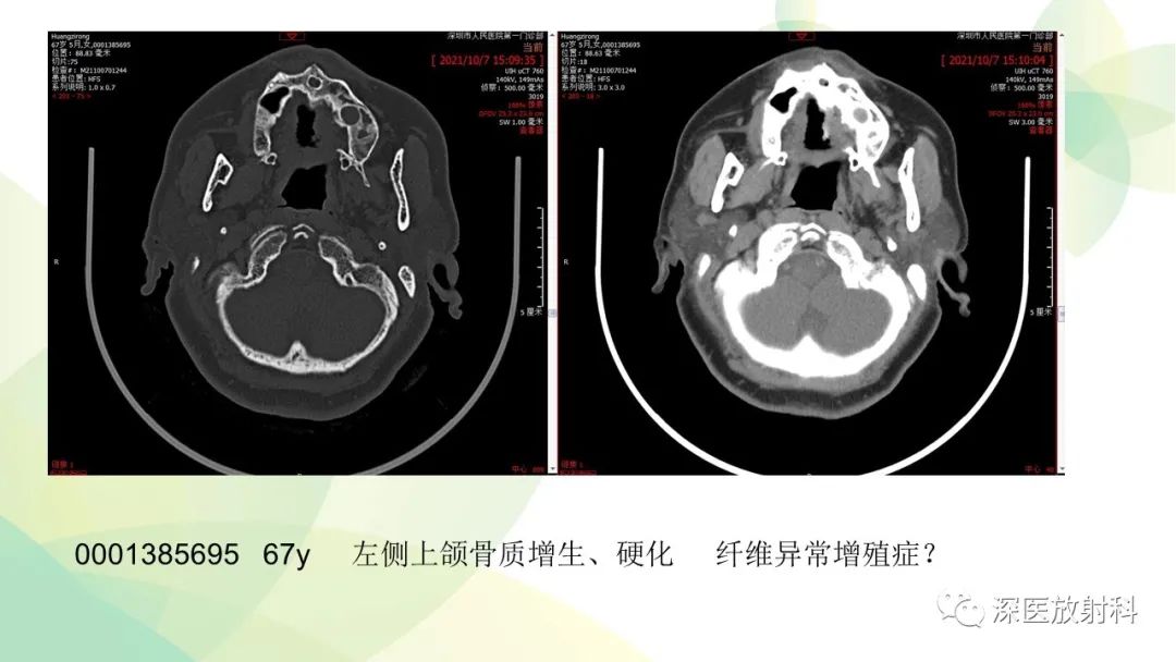 影像PPT - 【PPT】颌骨病变的影像表现-52
