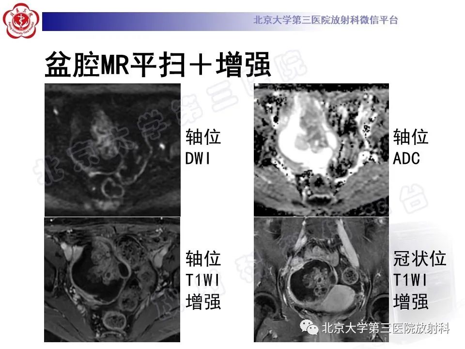 影像PPT - 【PPT】卵巢未成熟畸胎瘤-4