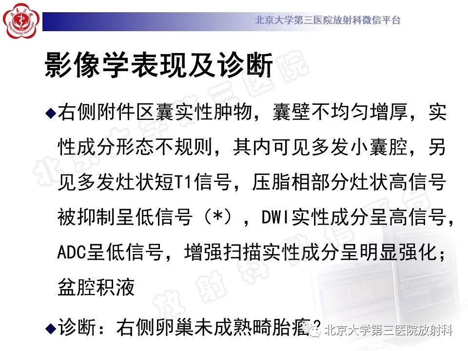 影像PPT - 【PPT】卵巢未成熟畸胎瘤-5