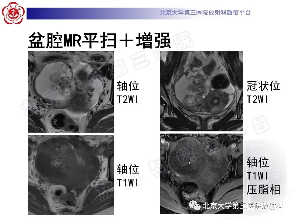 Ppt 卵巢未成熟畸胎瘤 影像ppt