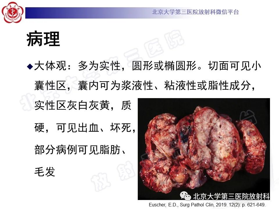 影像PPT - 【PPT】卵巢未成熟畸胎瘤-10