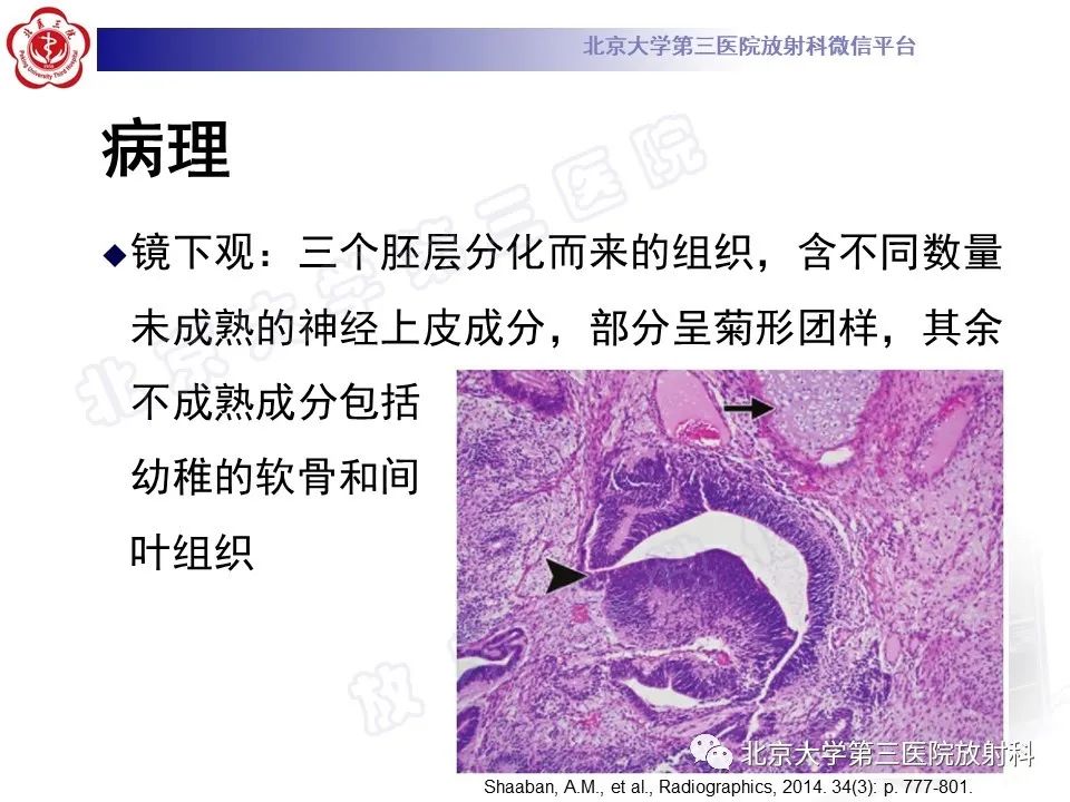影像PPT - 【PPT】卵巢未成熟畸胎瘤-11