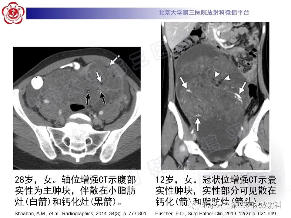 影像PPT - 【PPT】卵巢未成熟畸胎瘤-16