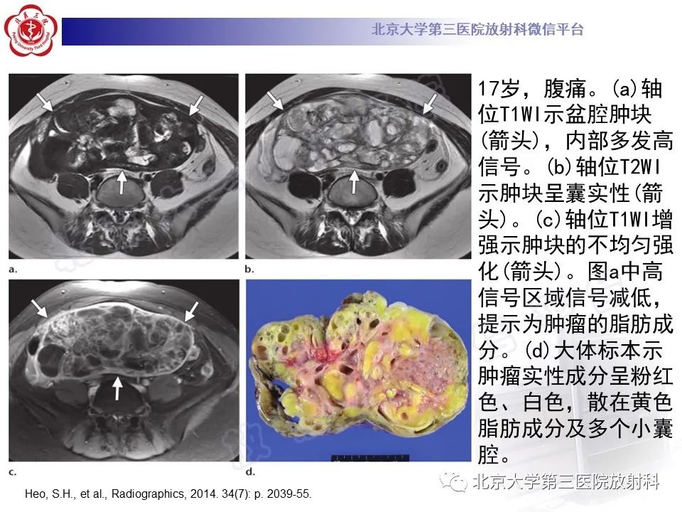 影像PPT - 【PPT】卵巢未成熟畸胎瘤-17