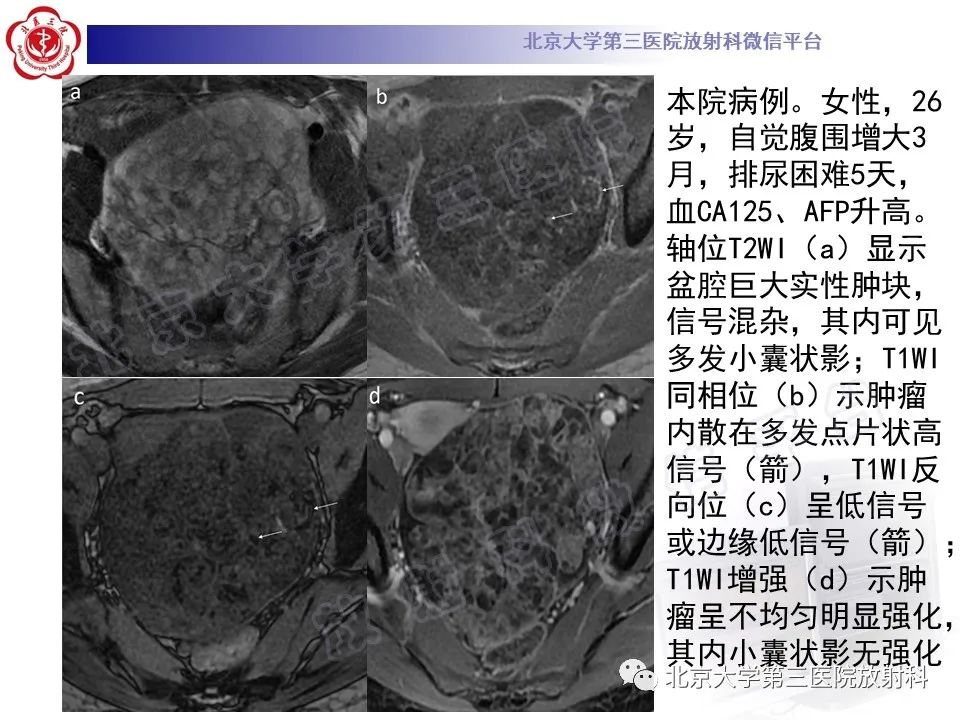 影像PPT - 【PPT】卵巢未成熟畸胎瘤-18