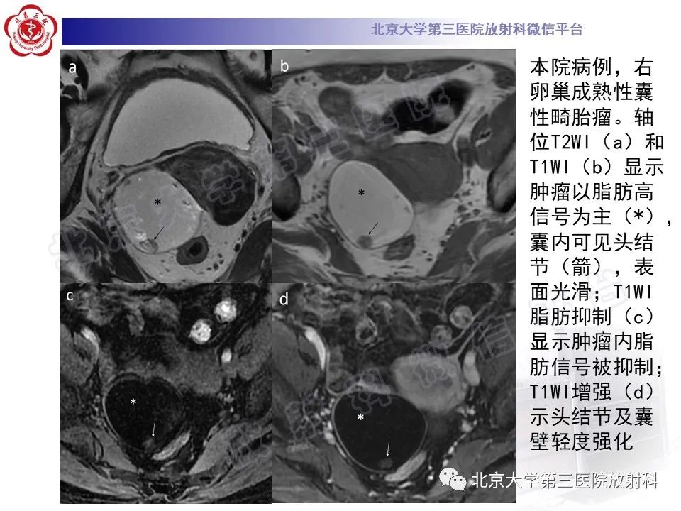 影像PPT - 【PPT】卵巢未成熟畸胎瘤-21