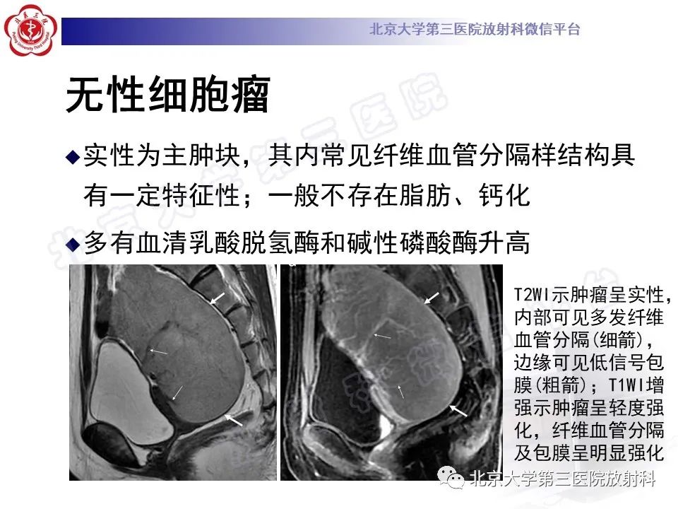 影像PPT - 【PPT】卵巢未成熟畸胎瘤-23