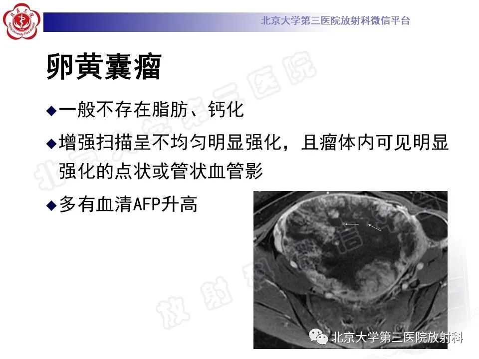 影像PPT - 【PPT】卵巢未成熟畸胎瘤-24