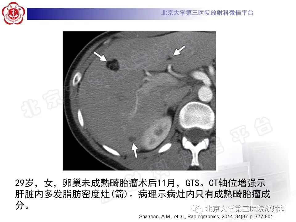 影像PPT - 【PPT】卵巢未成熟畸胎瘤-27