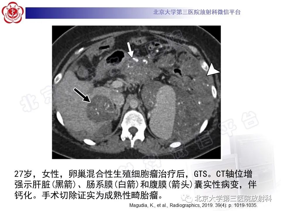 影像PPT - 【PPT】卵巢未成熟畸胎瘤-28