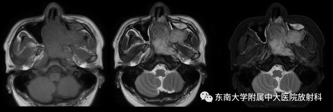 影像PPT - 【PPT】鼻咽纤维血管瘤-1 影像PPT - 【PPT】鼻咽纤维血管瘤-1