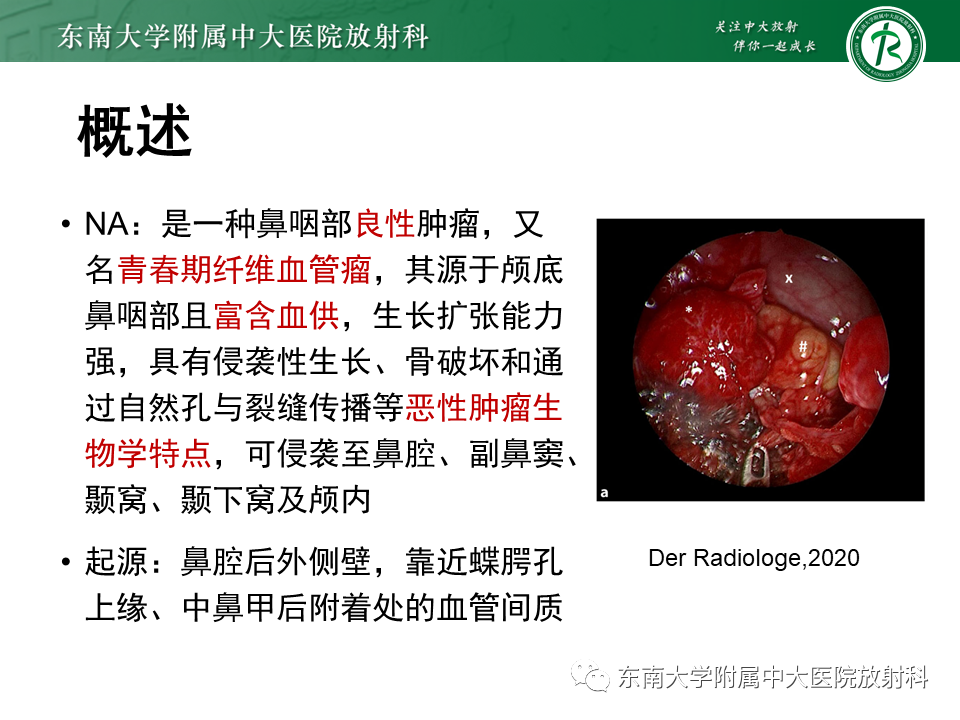 影像PPT - 【PPT】鼻咽纤维血管瘤-7 影像PPT - 【PPT】鼻咽纤维血管瘤-7