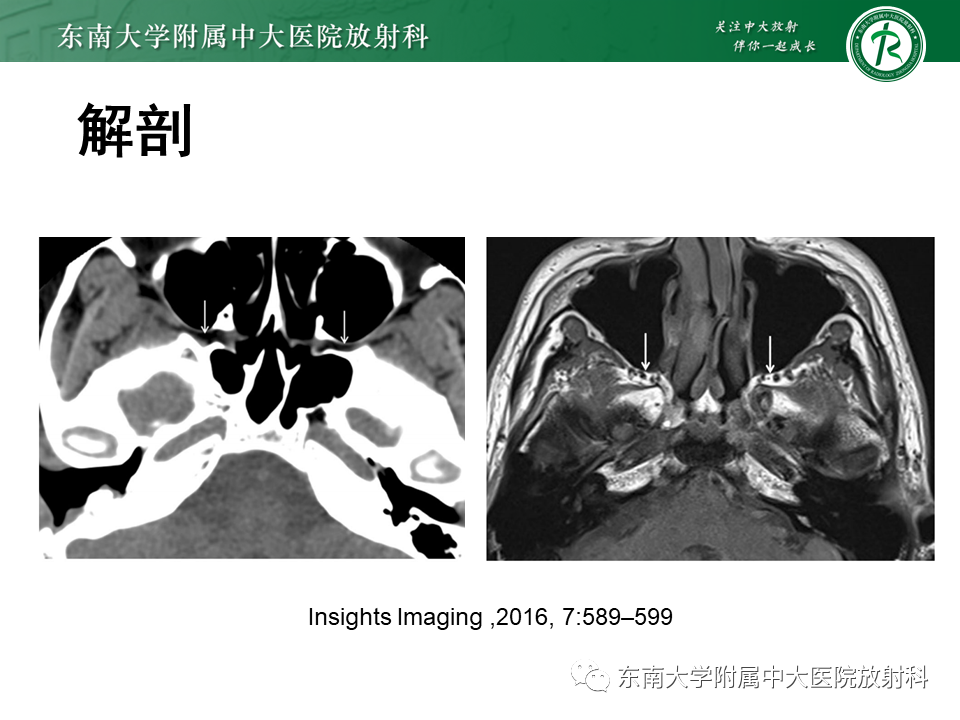 影像PPT - 【PPT】鼻咽纤维血管瘤-14 影像PPT - 【PPT】鼻咽纤维血管瘤-14