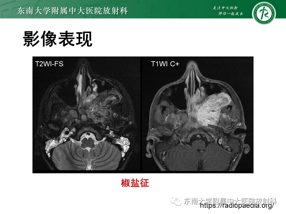 影像PPT - 【PPT】鼻咽纤维血管瘤-21 影像PPT - 【PPT】鼻咽纤维血管瘤-21