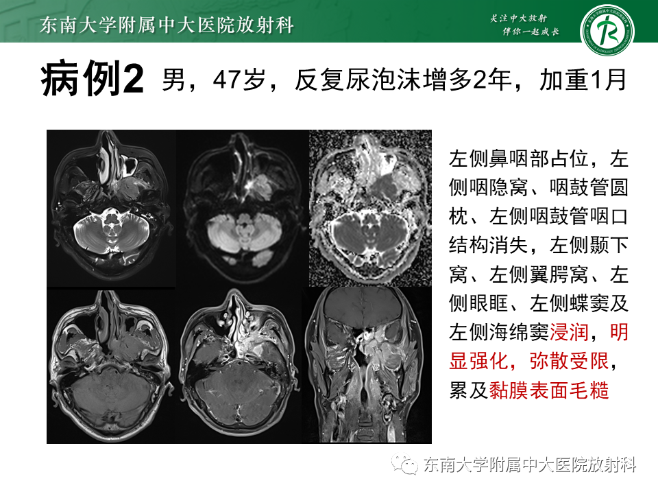 影像PPT - 【PPT】鼻咽纤维血管瘤-24 影像PPT - 【PPT】鼻咽纤维血管瘤-24