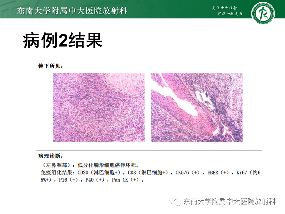 影像PPT - 【PPT】鼻咽纤维血管瘤-25 影像PPT - 【PPT】鼻咽纤维血管瘤-25