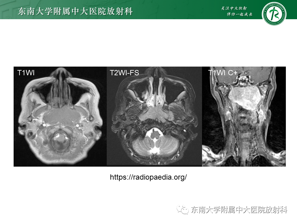 影像PPT - 【PPT】鼻咽纤维血管瘤-27 影像PPT - 【PPT】鼻咽纤维血管瘤-27