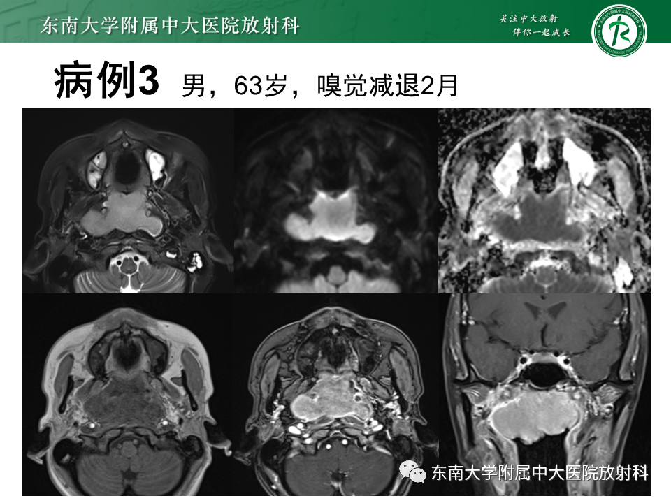 影像PPT - 【PPT】鼻咽纤维血管瘤-28 影像PPT - 【PPT】鼻咽纤维血管瘤-28