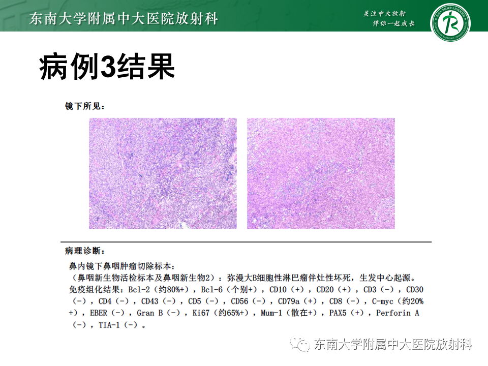 影像PPT - 【PPT】鼻咽纤维血管瘤-29 影像PPT - 【PPT】鼻咽纤维血管瘤-29