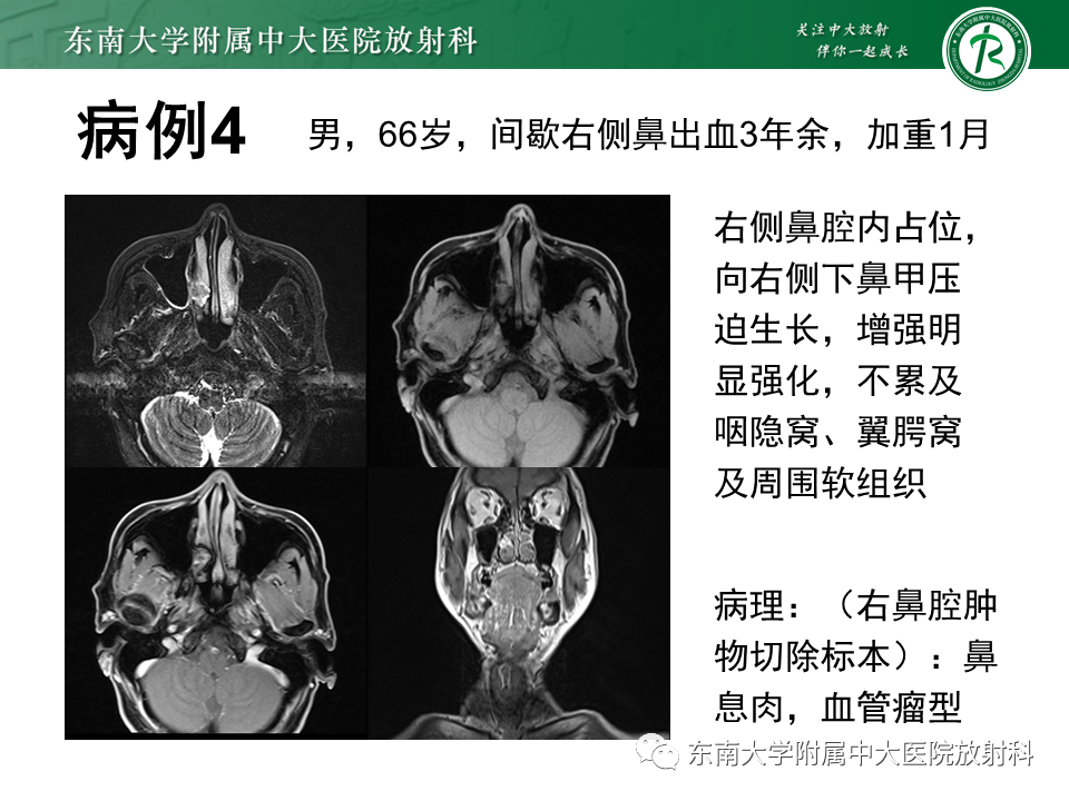 影像PPT - 【PPT】鼻咽纤维血管瘤-31 影像PPT - 【PPT】鼻咽纤维血管瘤-31