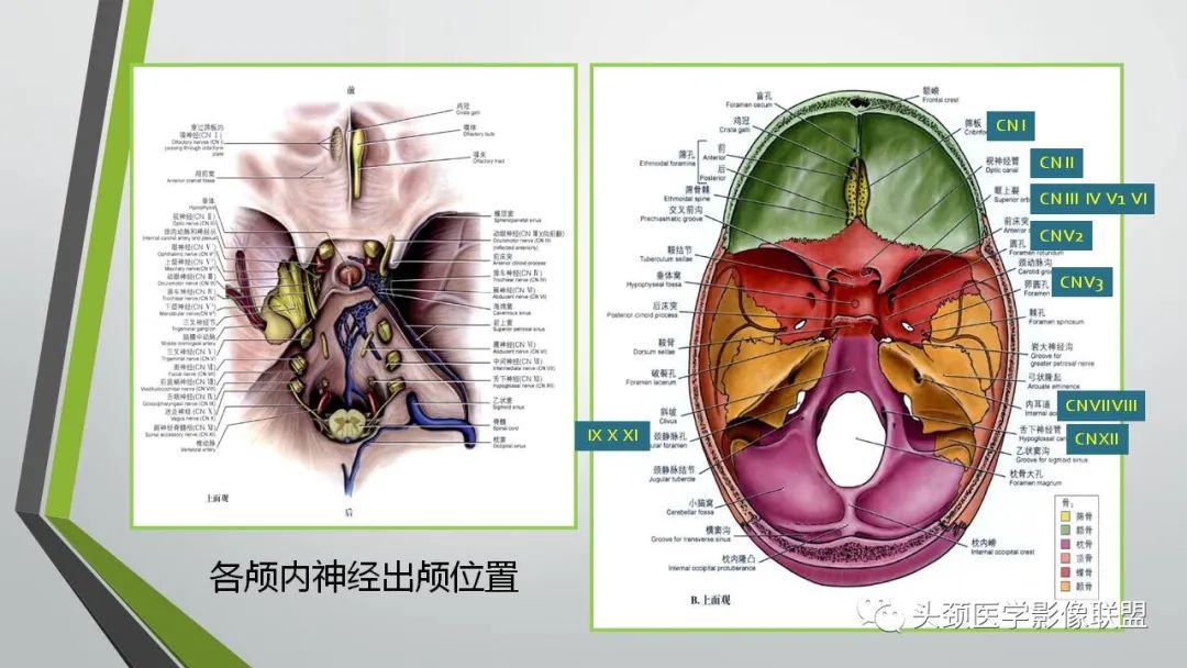 影像PPT - 【PPT】颅内神经影像解剖与病例-5