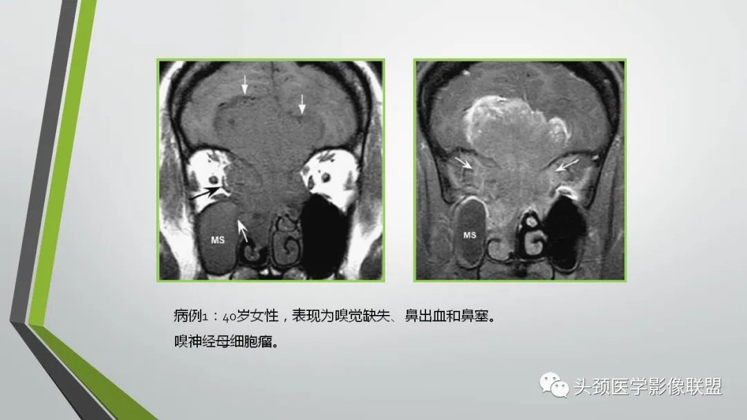 影像PPT - 【PPT】颅内神经影像解剖与病例-12