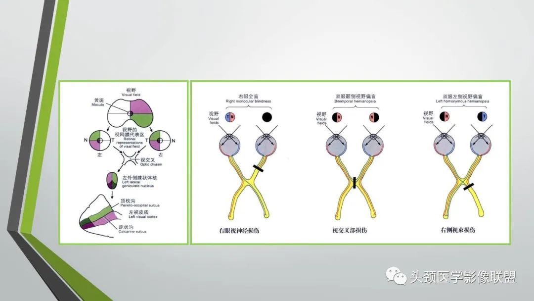 影像PPT - 【PPT】颅内神经影像解剖与病例-15
