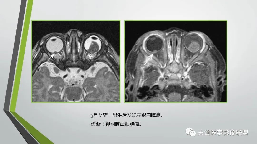 影像PPT - 【PPT】颅内神经影像解剖与病例-21