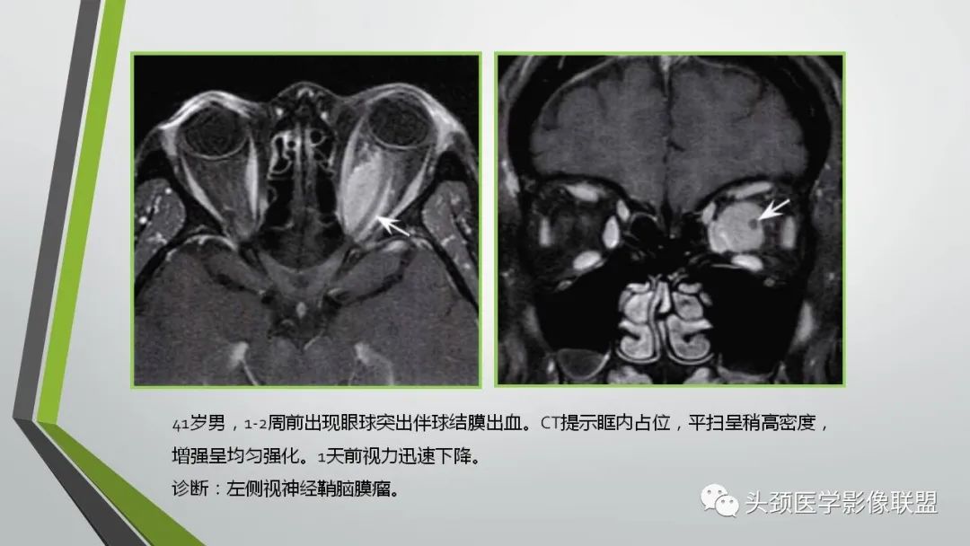 影像PPT - 【PPT】颅内神经影像解剖与病例-22