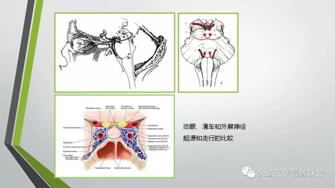 影像PPT - 【PPT】颅内神经影像解剖与病例-27