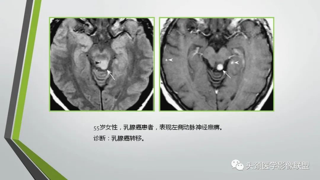 影像PPT - 【PPT】颅内神经影像解剖与病例-29
