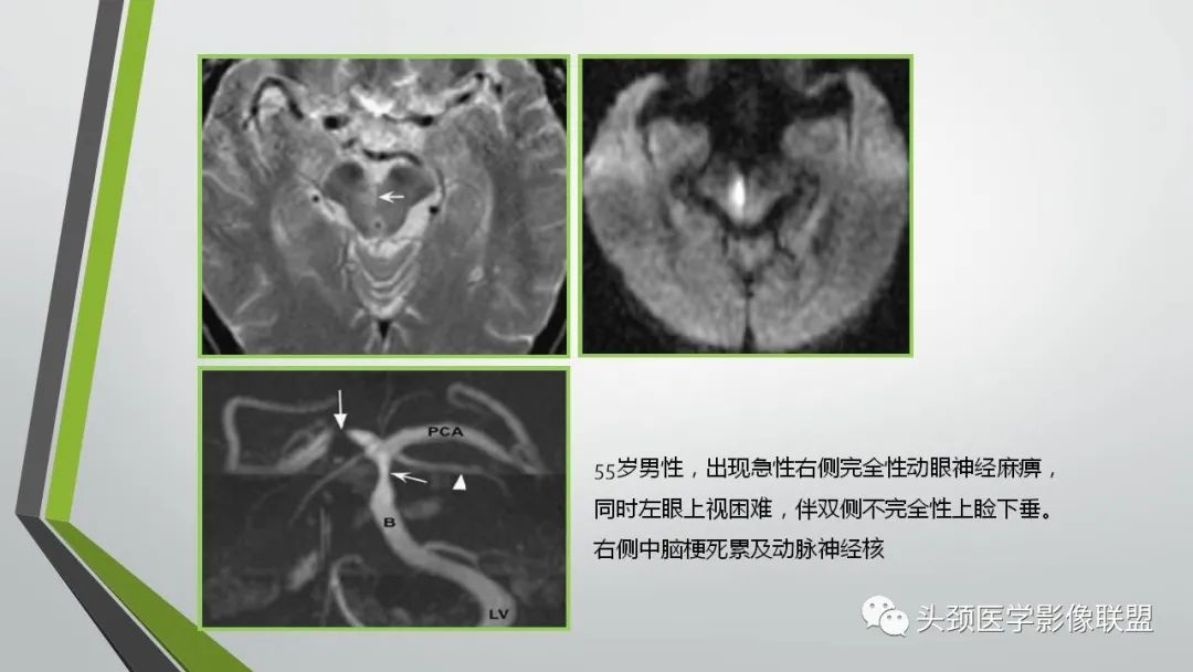 影像PPT - 【PPT】颅内神经影像解剖与病例-30
