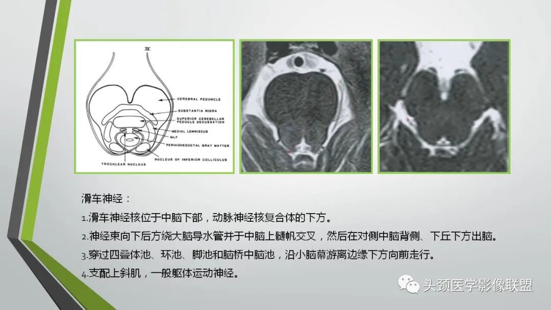 影像PPT - 【PPT】颅内神经影像解剖与病例-32