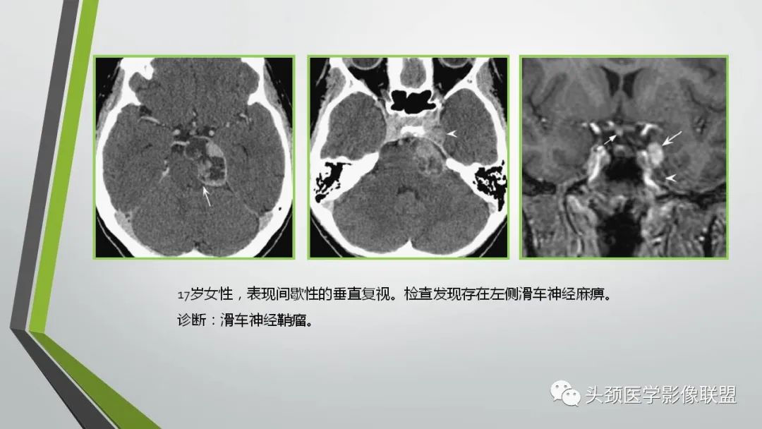 影像PPT - 【PPT】颅内神经影像解剖与病例-33