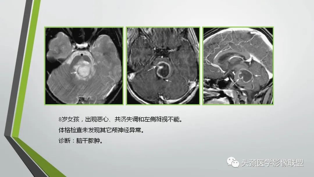 影像PPT - 【PPT】颅内神经影像解剖与病例-35