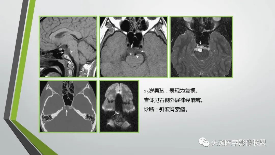 影像PPT - 【PPT】颅内神经影像解剖与病例-36