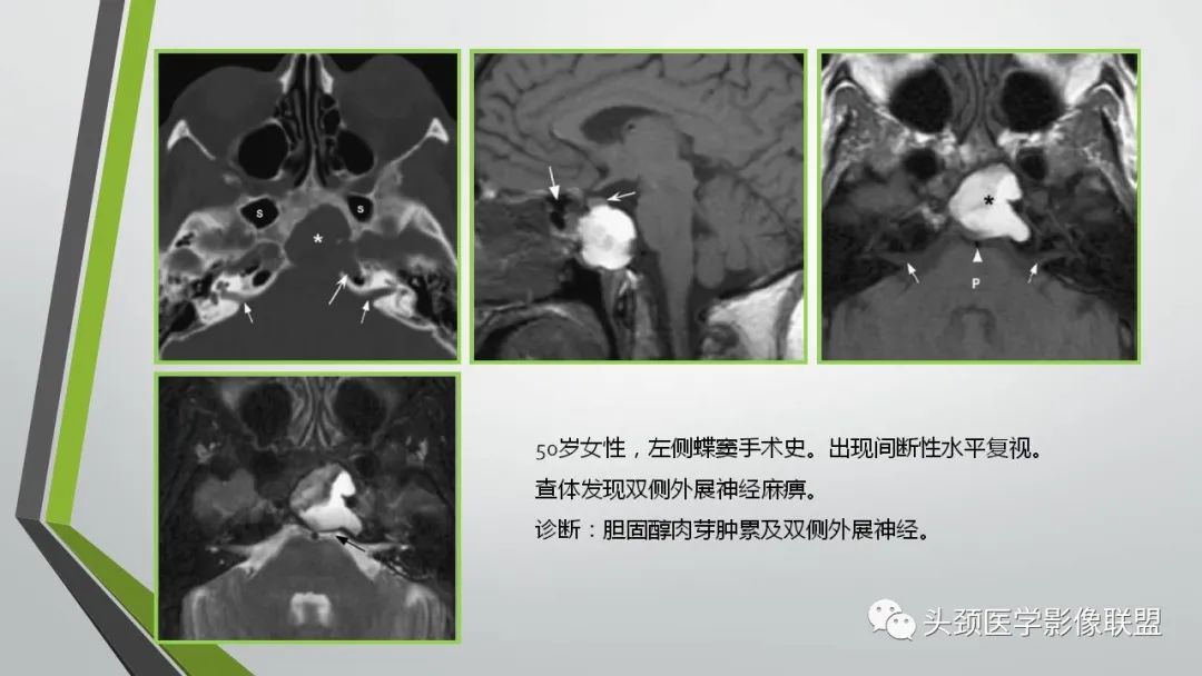 影像PPT - 【PPT】颅内神经影像解剖与病例-37