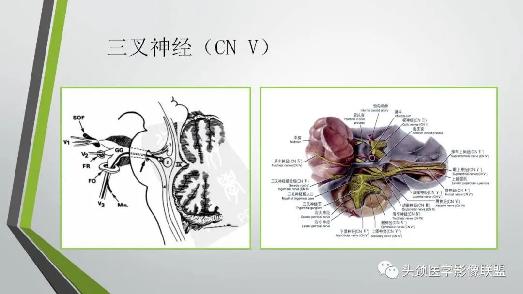 影像PPT - 【PPT】颅内神经影像解剖与病例-38