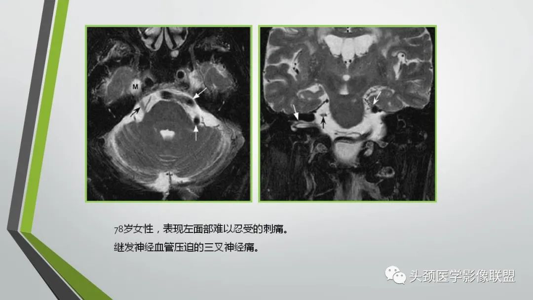 影像PPT - 【PPT】颅内神经影像解剖与病例-45