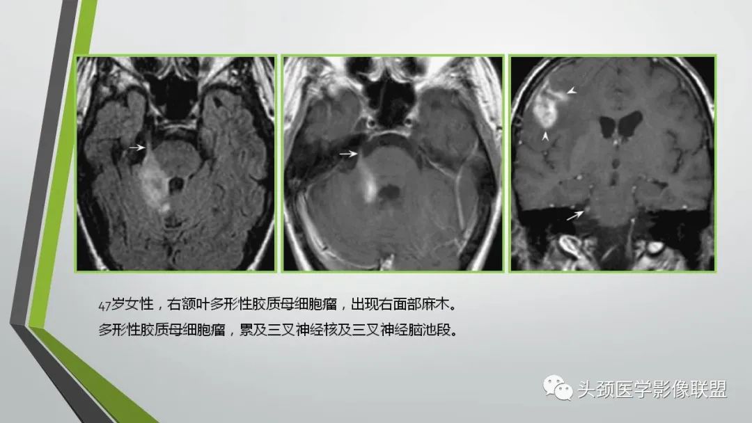 影像PPT - 【PPT】颅内神经影像解剖与病例-46