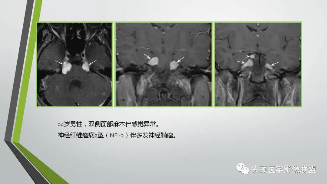 影像PPT - 【PPT】颅内神经影像解剖与病例-47