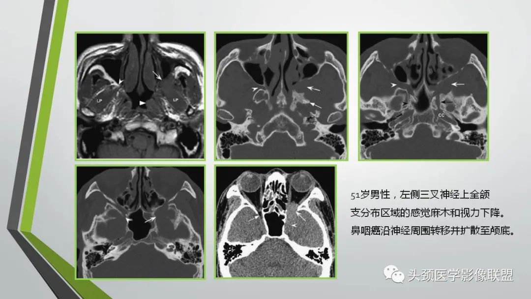 影像PPT - 【PPT】颅内神经影像解剖与病例-48