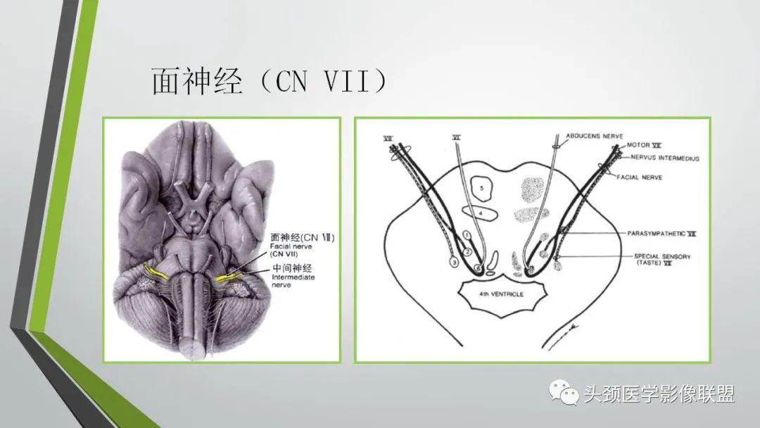 影像PPT - 【PPT】颅内神经影像解剖与病例-49