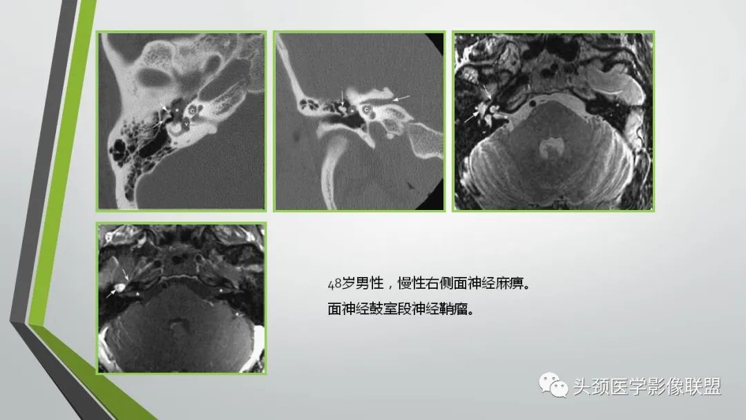 影像PPT - 【PPT】颅内神经影像解剖与病例-56
