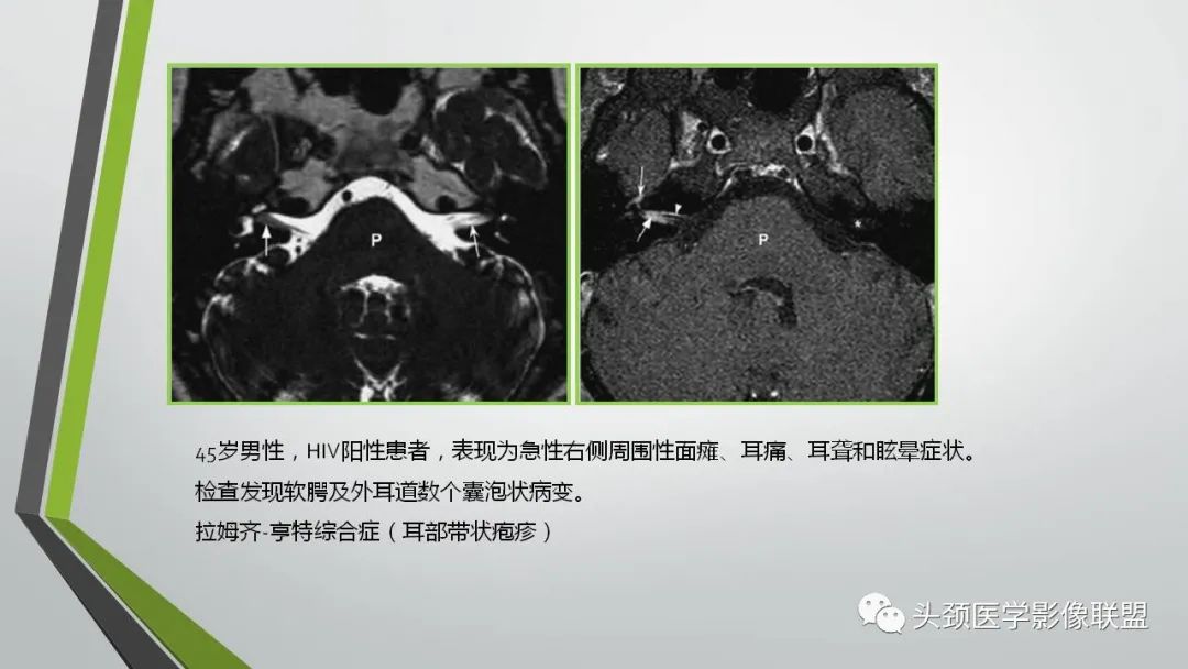 影像PPT - 【PPT】颅内神经影像解剖与病例-55