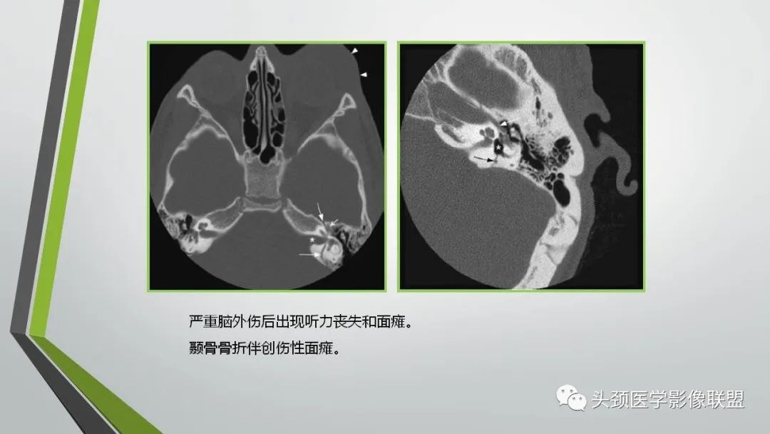 影像PPT - 【PPT】颅内神经影像解剖与病例-57