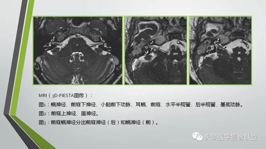 影像PPT - 【PPT】颅内神经影像解剖与病例-66